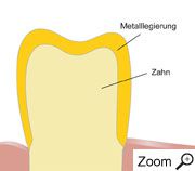 Vollgusskrone